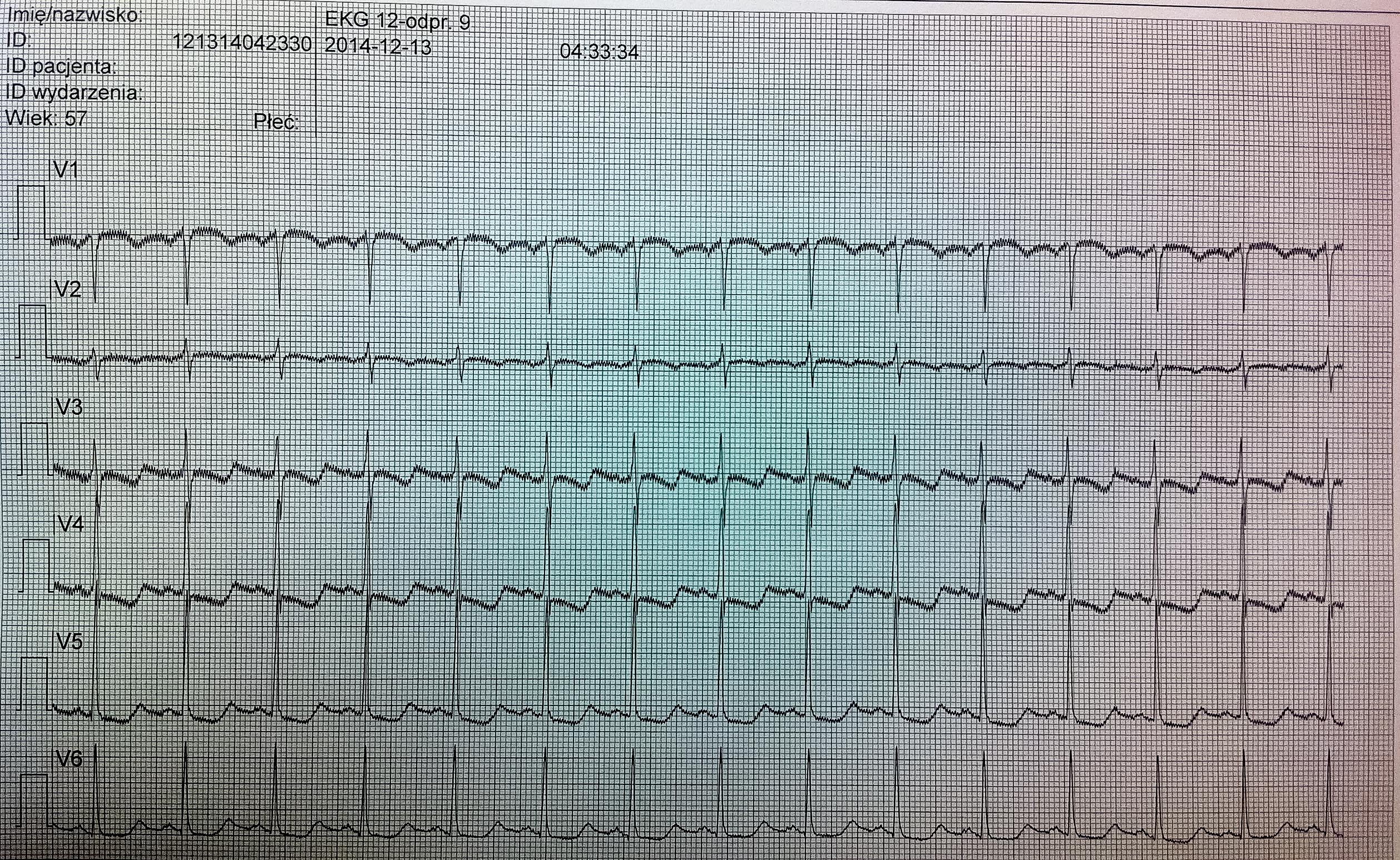 EKG z teletransmisji EKG z teletransmisji