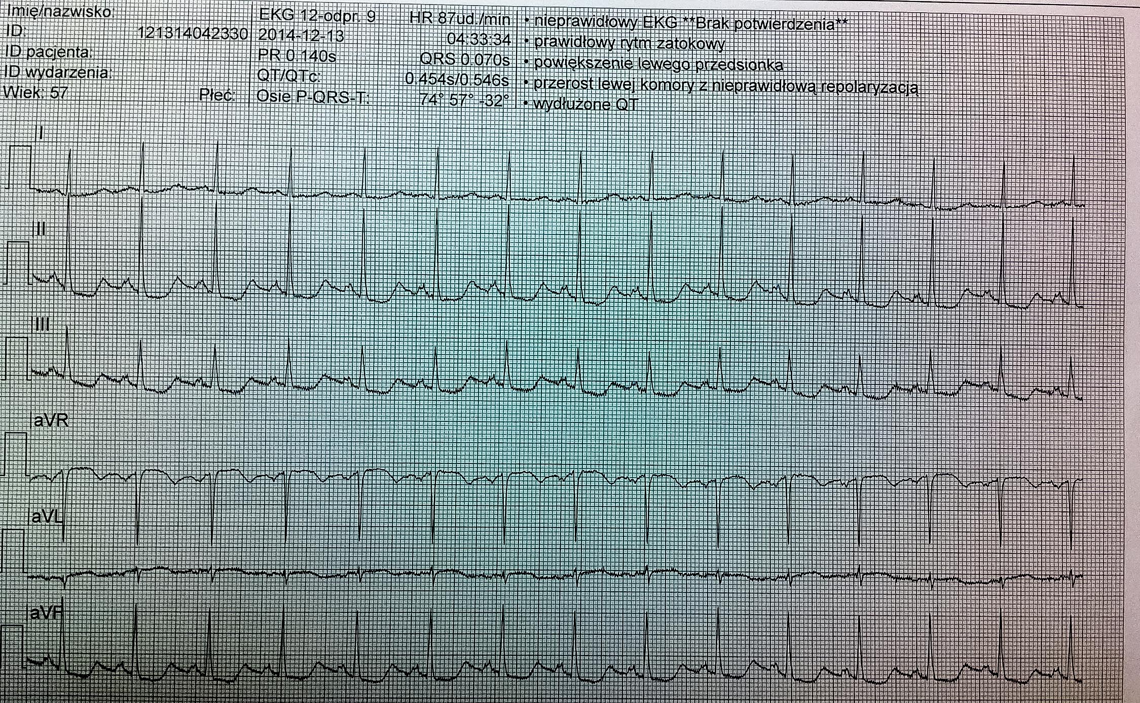 EKG z teletransmisji EKG z teletransmisji