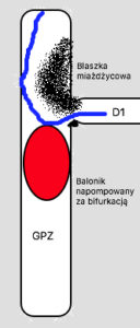 Manewr oparcia prowadnika na wypełnionym w GPZ balonie